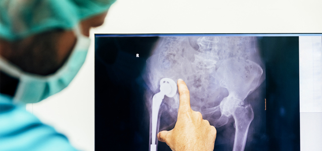 Metal Hip Side Effects