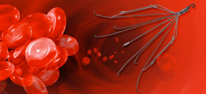 Jury Awards Victim $34 Million for Defective IVC Filter