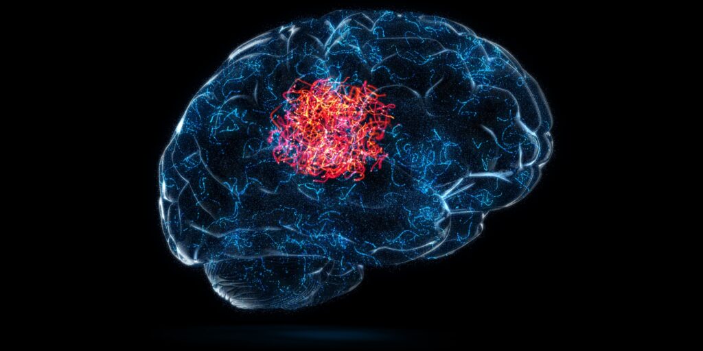 Meningioma brain tumor from the Depo Provera birth control shot